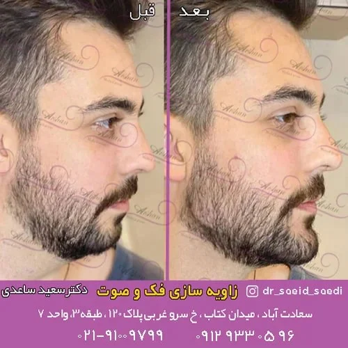 مقایسه تزریق فیلر و تزریق چربی برای کانتورینگ صورت