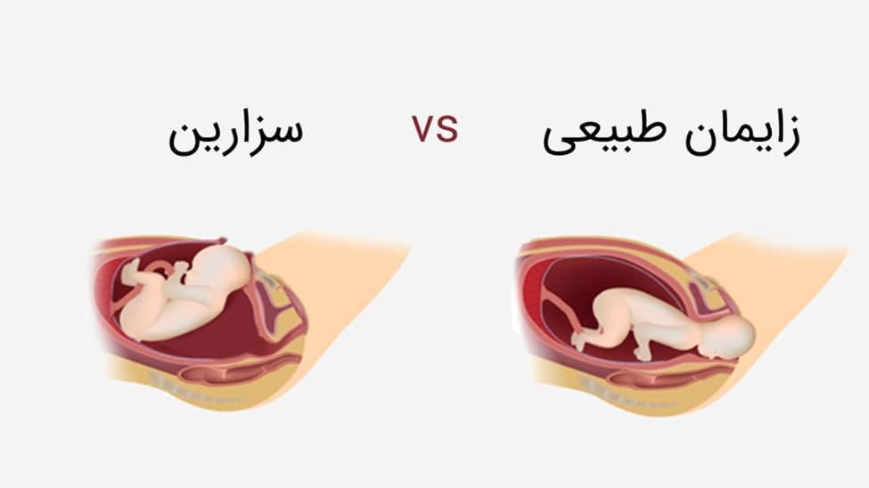 سزارین یا زایمان طبیعی؟ بهترین زمان سزارین و مراقبت‌های بعد از آن