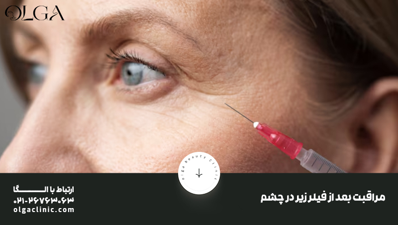 مشاوره | متخصص مراقبت بعد از فیلر زیر در چشم