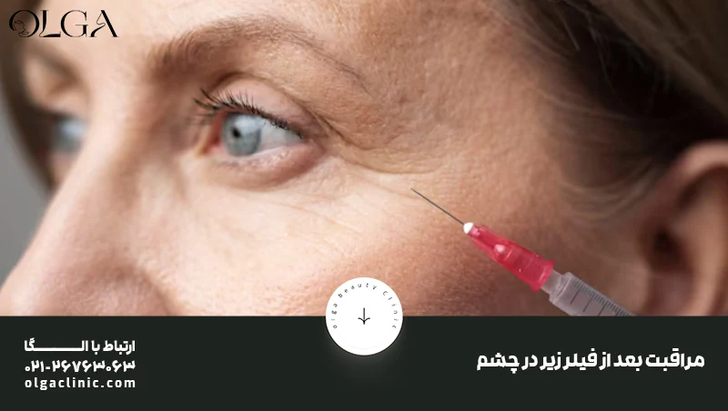 مراقبت بعد از فیلر زیر در چشم&nbsp;